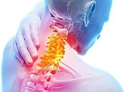 Síntomas de osteocondosis cervical y reglas nutricionales para la enfermedad