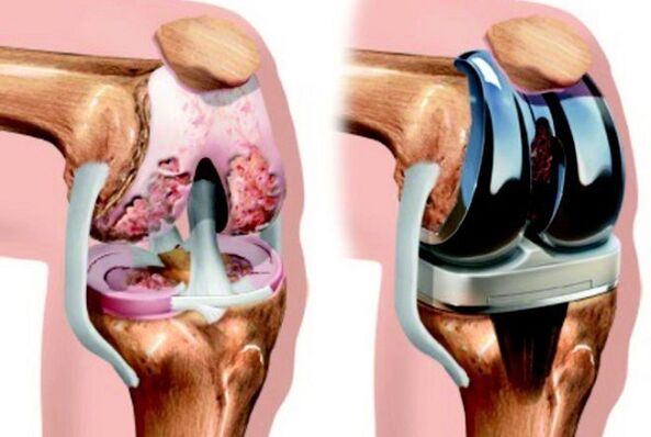 Antes y después de la endoprotética de la articulación de la rodilla con artrosis