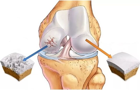 Cartílago y cartílago saludables afectados por la osteoartritis