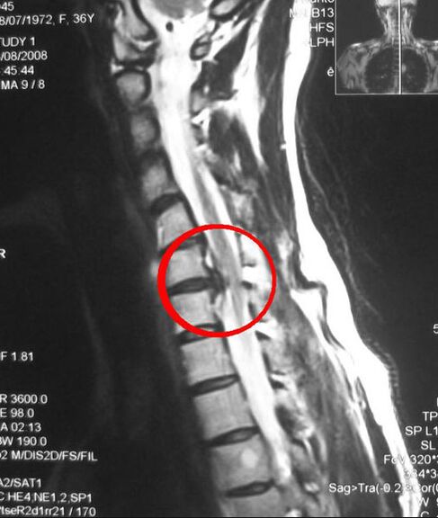 Síntomas de osteocondrosis torácica en una radiografía. 